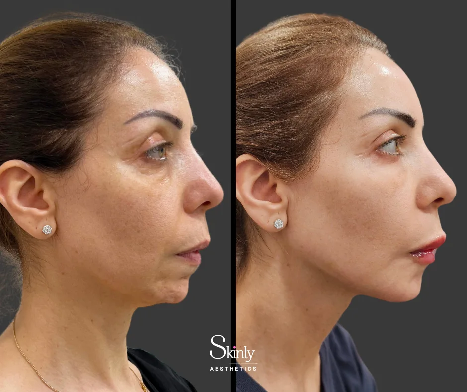 Profile view of before and after liquid facelift, showing lifted cheeks and jawline.