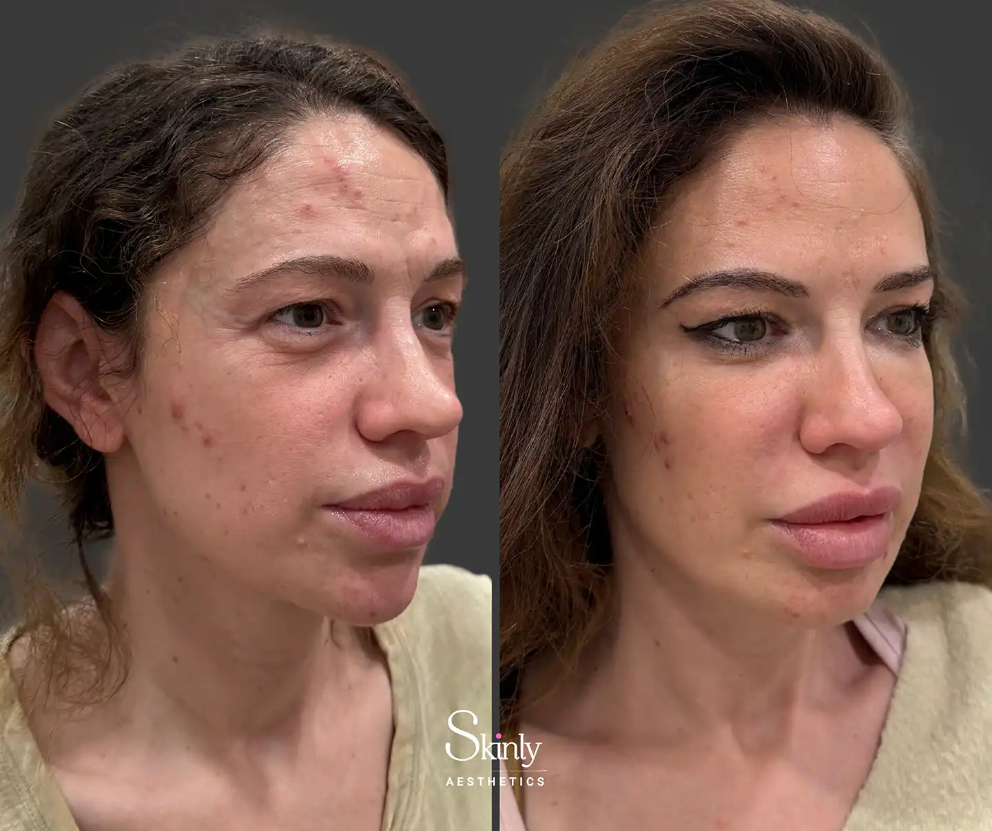 Side view showing lifted and defined cheek contours after liquid facelift