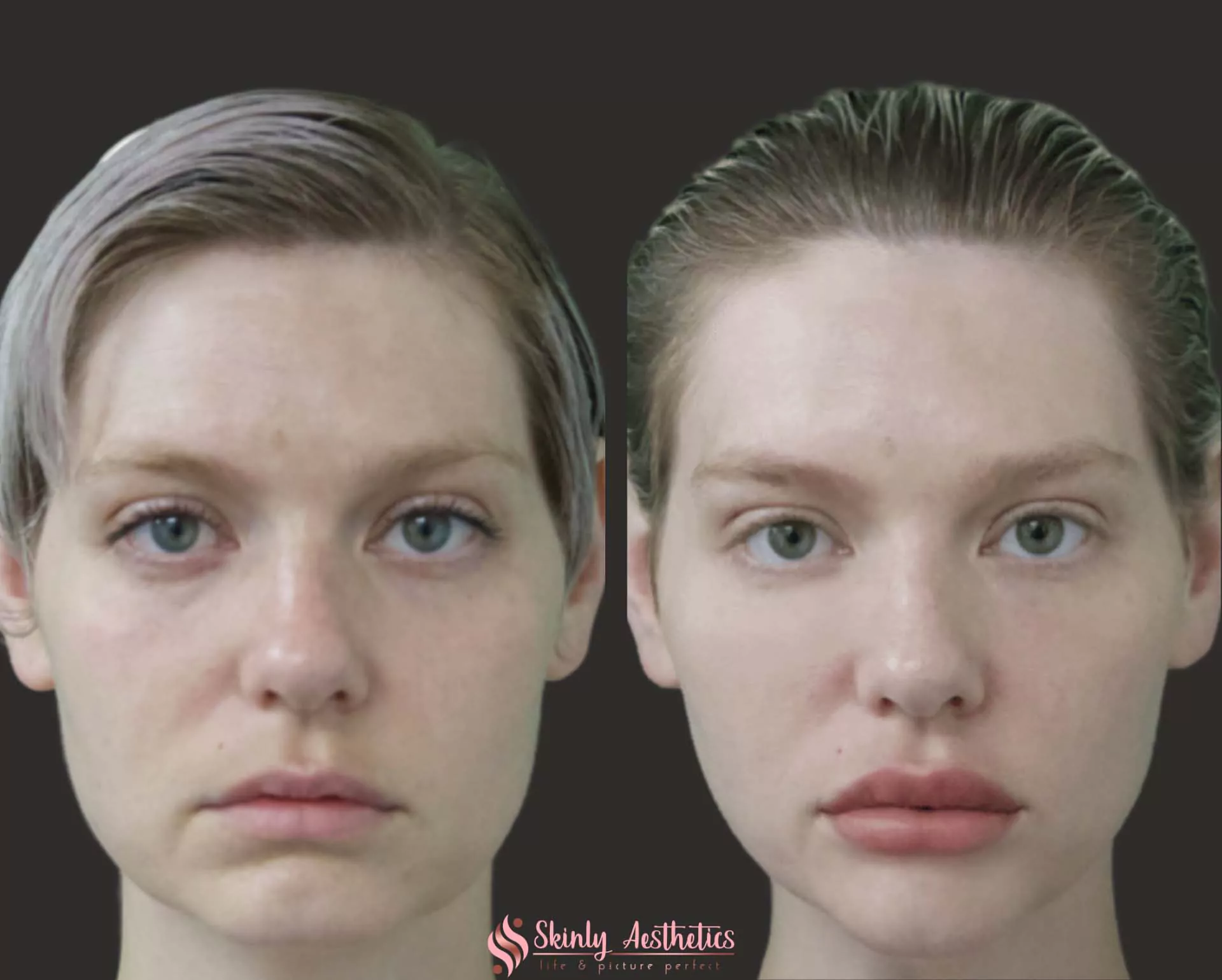 juvederm ultra lip augmentation