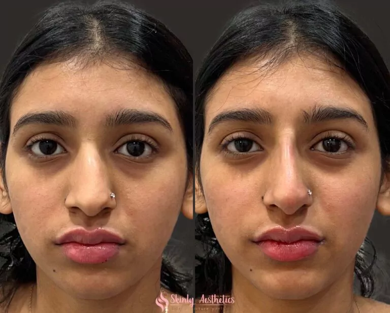 liquid nose job to raise and augment the nose bridge