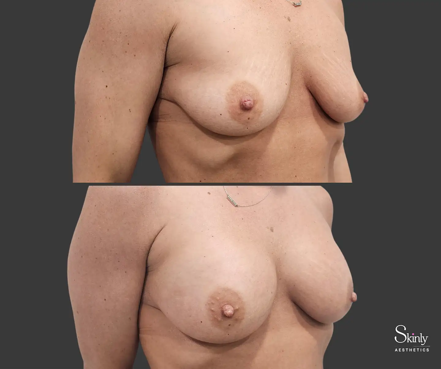 Non-surgical breast enhancement before and after results at a 45 degree angle