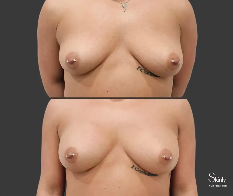 Breast asymmetry corrected using liquid breast lift
