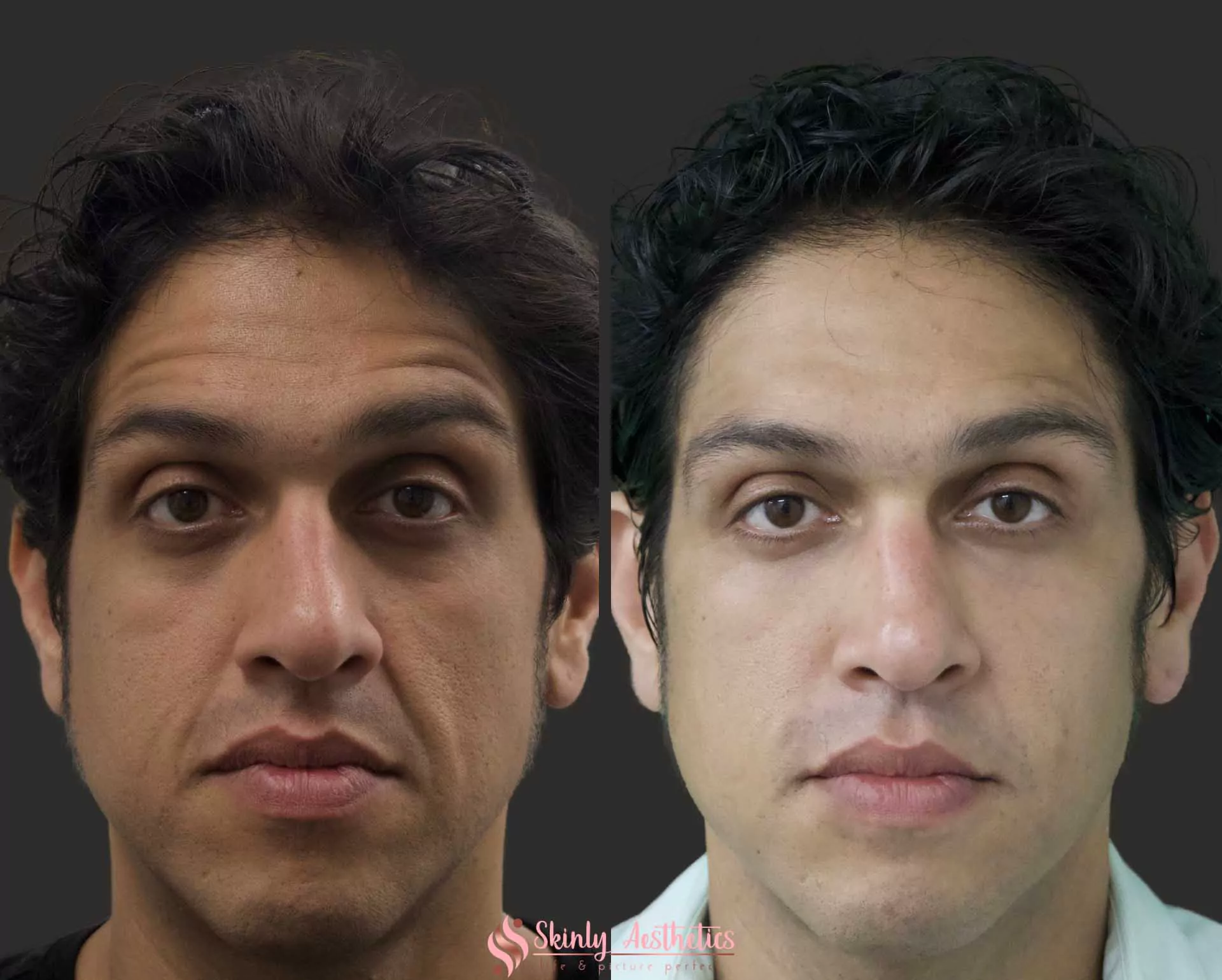 under eye dark circles treated with Juvederm dermal filler