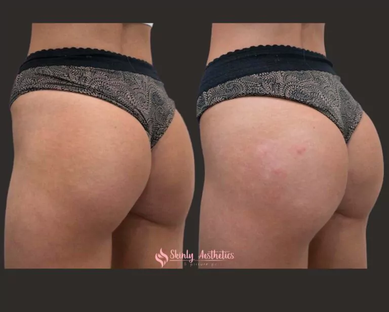 scuptra hips treatment