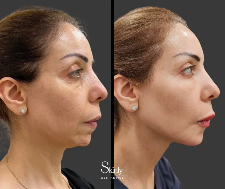 Before and after chin filler for facial rejuvenation.