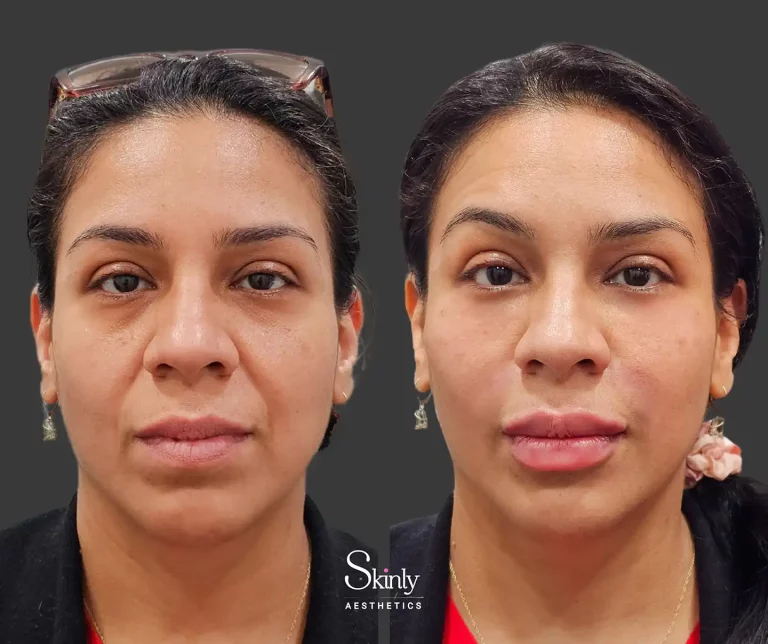 Front view highlighting smoother skin texture and diminished under-eye hollowness post-liquid facelift