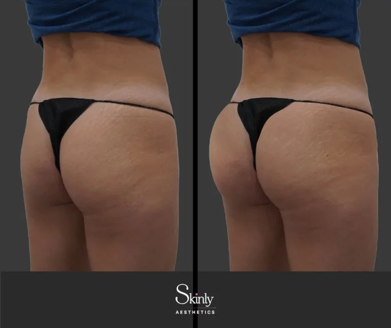 Before and after liquid butt lift for improved symmetry.