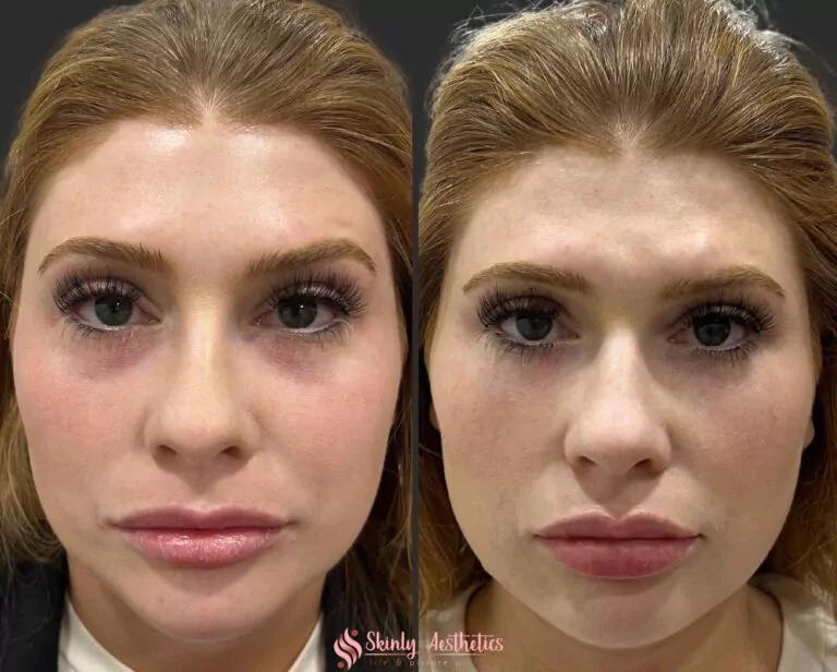 under eye dark circles correction