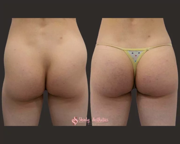Sculptra hip dips treatment