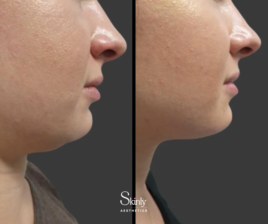 Before and after chin fat removal with Kybella, showing defined jawline.