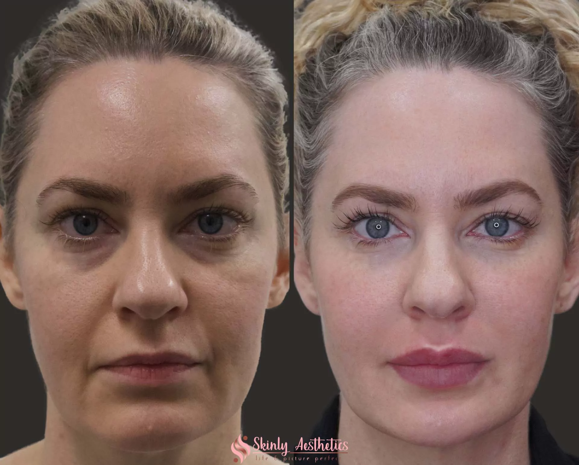 lip filler injection juvederm ultra