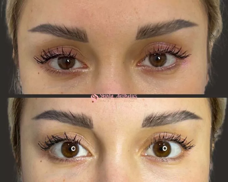 Upneeq eye drops to open the eyes and lift droopy upper eyelids