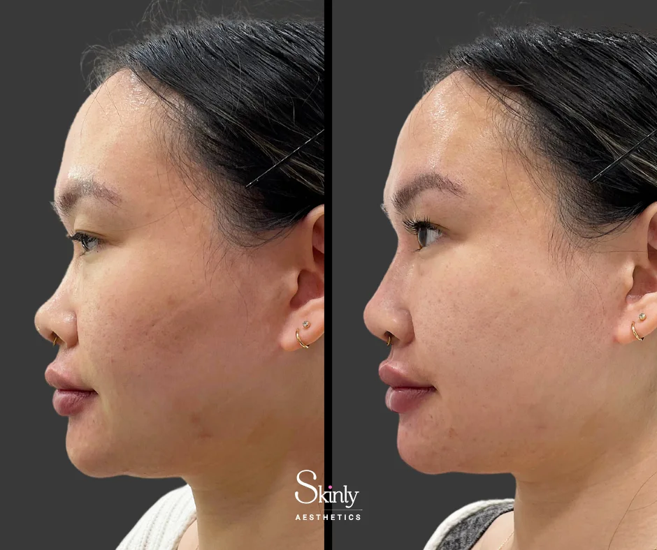Before and after nose tip filler, showing improved tip projection.
