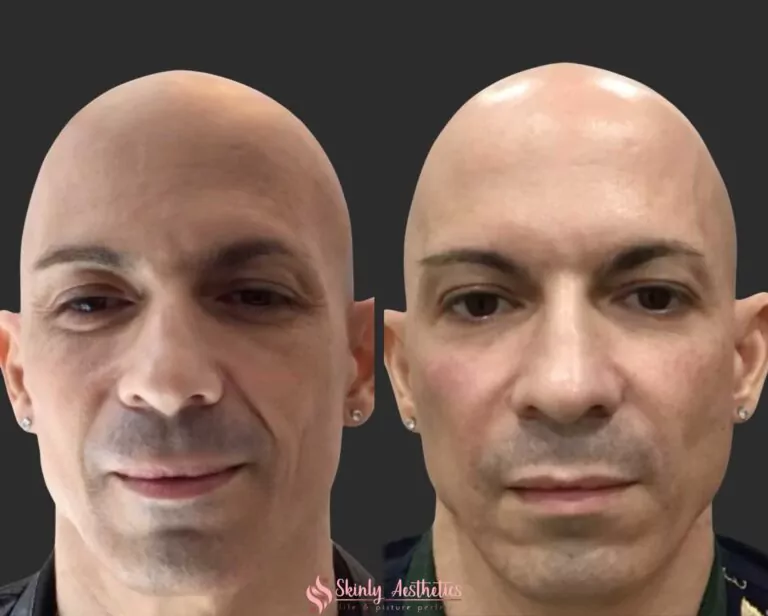 smoothing smile lines with Juvederm Ultra