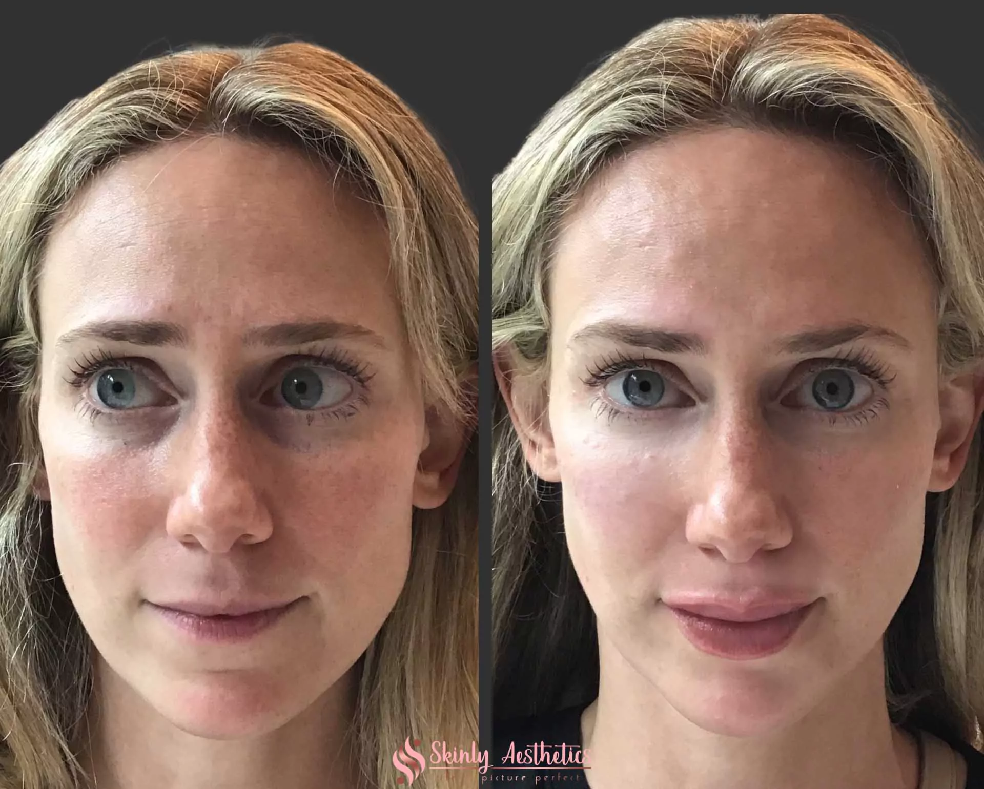 under eye circle treatment with Restylane filler