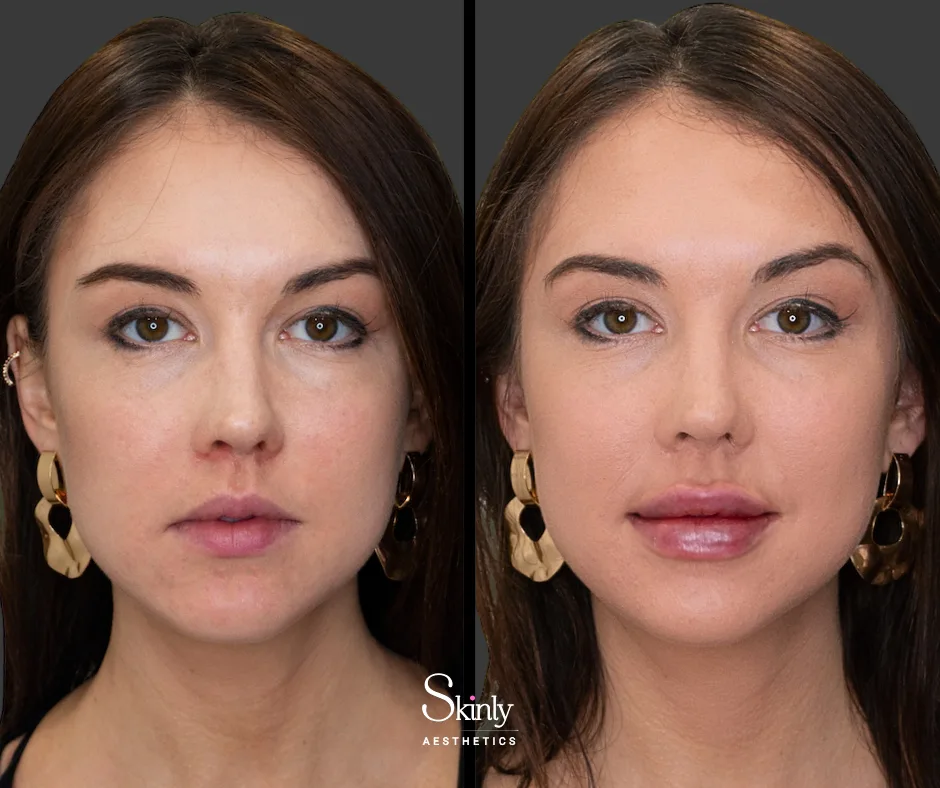 Before and after Russian lip filler, showing enhanced cupid’s bow definition.