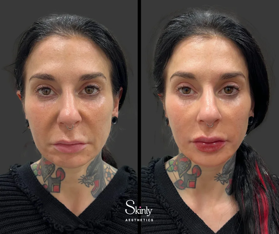 Before and after nasolabial fold correction, showing smoothed midface.