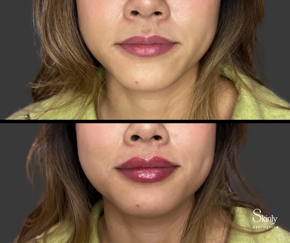 Close-up before and after lip filler showing lip symmetry.