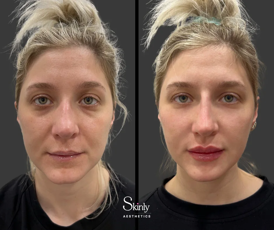Before and after cheek contouring with filler showing defined cheekbones.