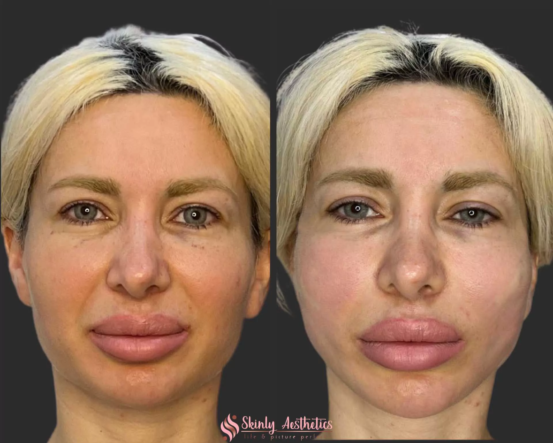 skin lifting and tightening with PDO threads