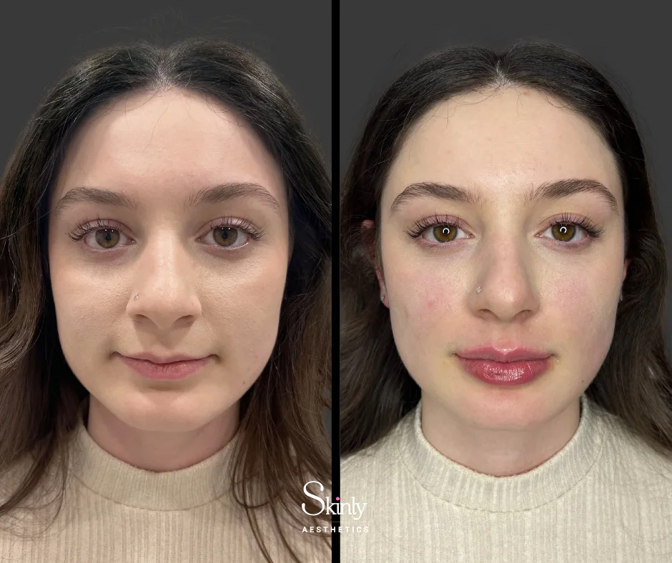 Before and after Russian lip filler, showing improved definition.