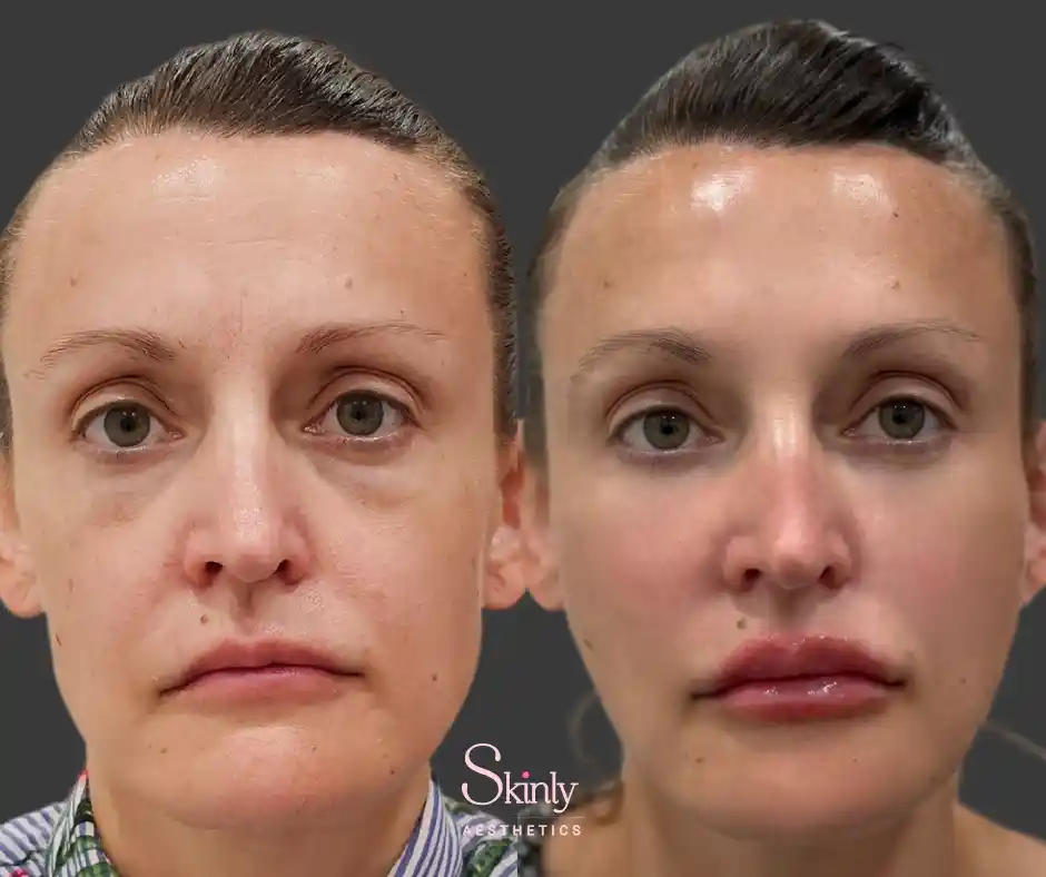 Liquid Facelift results showing instantly lifted cheeks, reduced smile lines and smooth under eyes