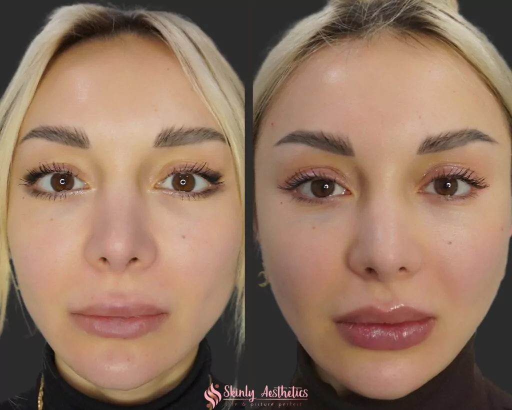 Russian technique lip filler injection