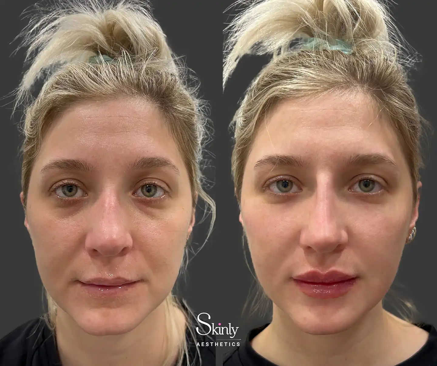 Front view demonstrating overall refreshed, youthful appearance from liquid facelift