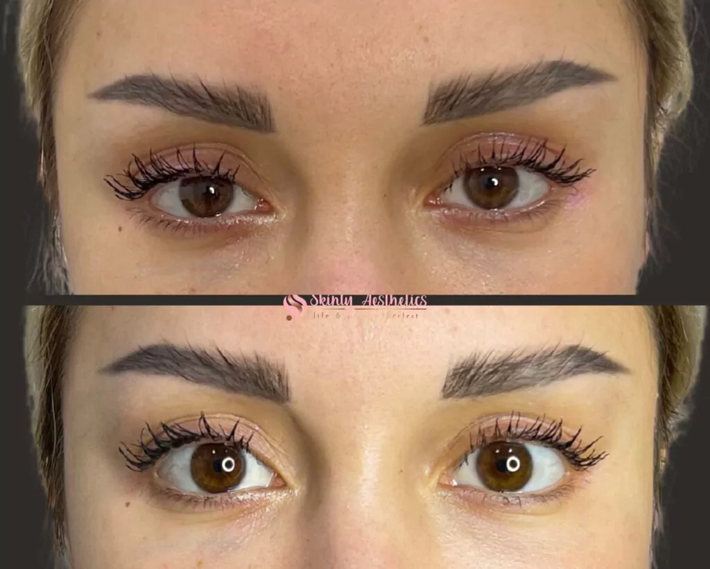Upneeq eye drops to open the eyes and lift droopy upper eyelids