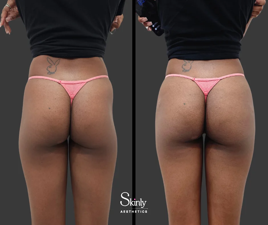Before and after Sculptra hip dip augmentation showing added hip volume.
