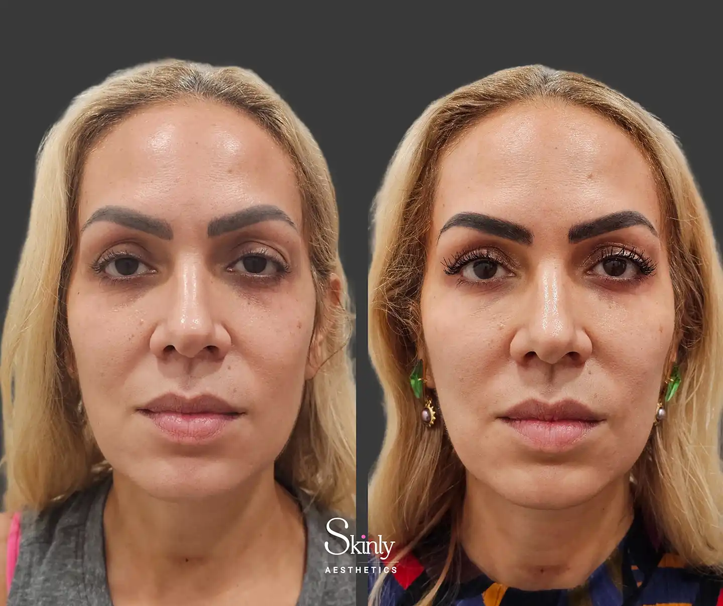 Liquid Facelift before and after photo showing restored under-eye and midface volume.