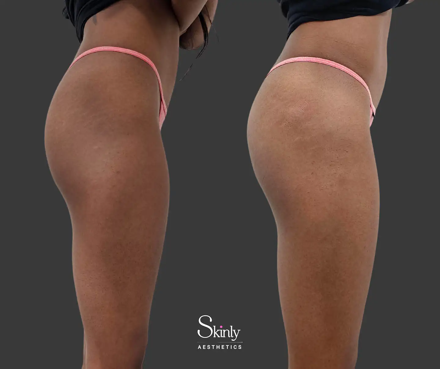 Non-surgical BBL results shown from side perspective