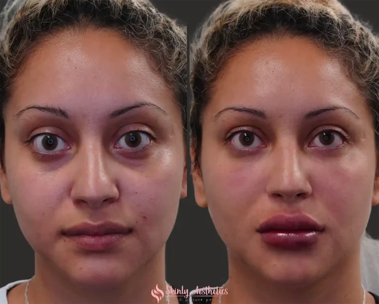 Full-face rejuvenation with Liquid Facelift: smoother skin, lifted features, younger appearance