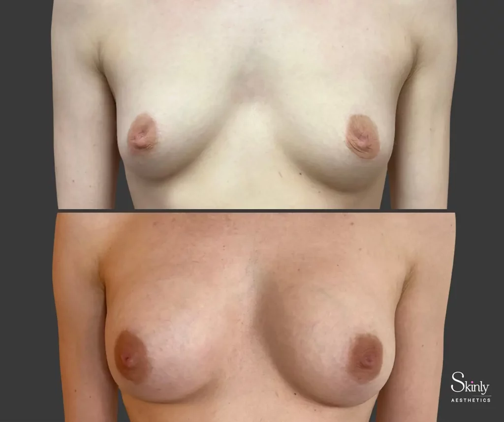 Before and after results of a liquid breast lift by Dr. Schwarzburg showing the transformation from small, sagging breasts to fuller, perky, and lifted breasts.