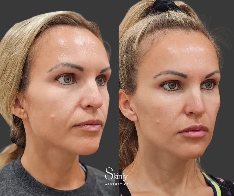 Side view of cheeks and nasolabial folds showing volume restoration from liquid facelift procedure