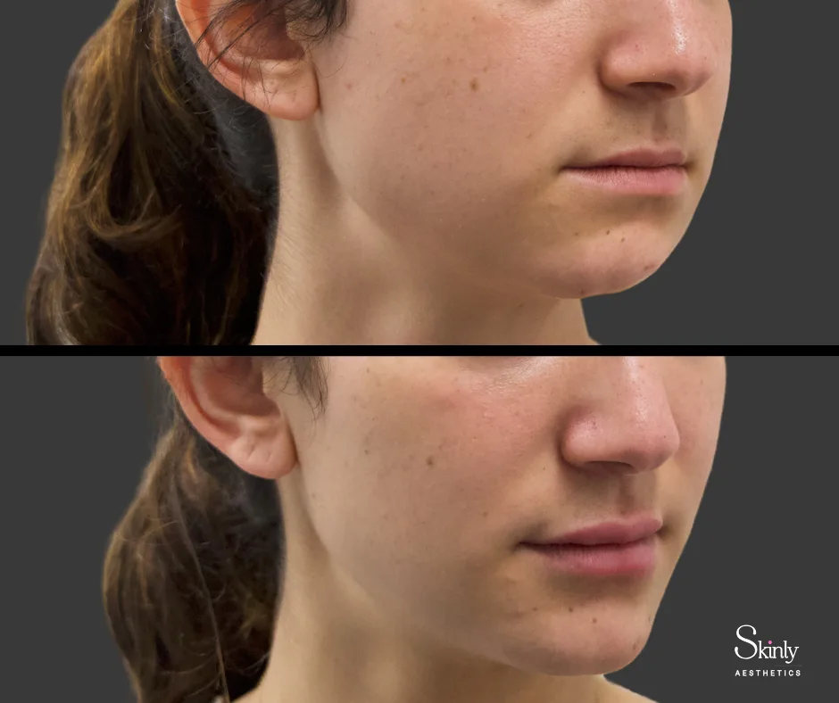 Before and after chin filler showing enhanced chin projection.