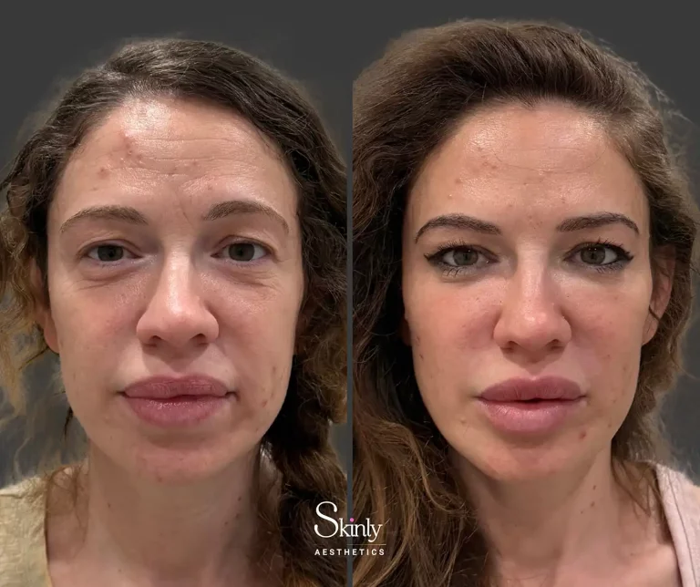 Front view showing dramatic improvement in deep facial wrinkles, folds, and volume loss after liquid facelift