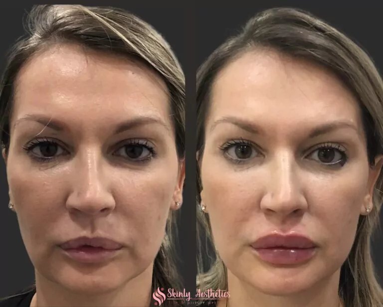 Russian style lip filler augmentation