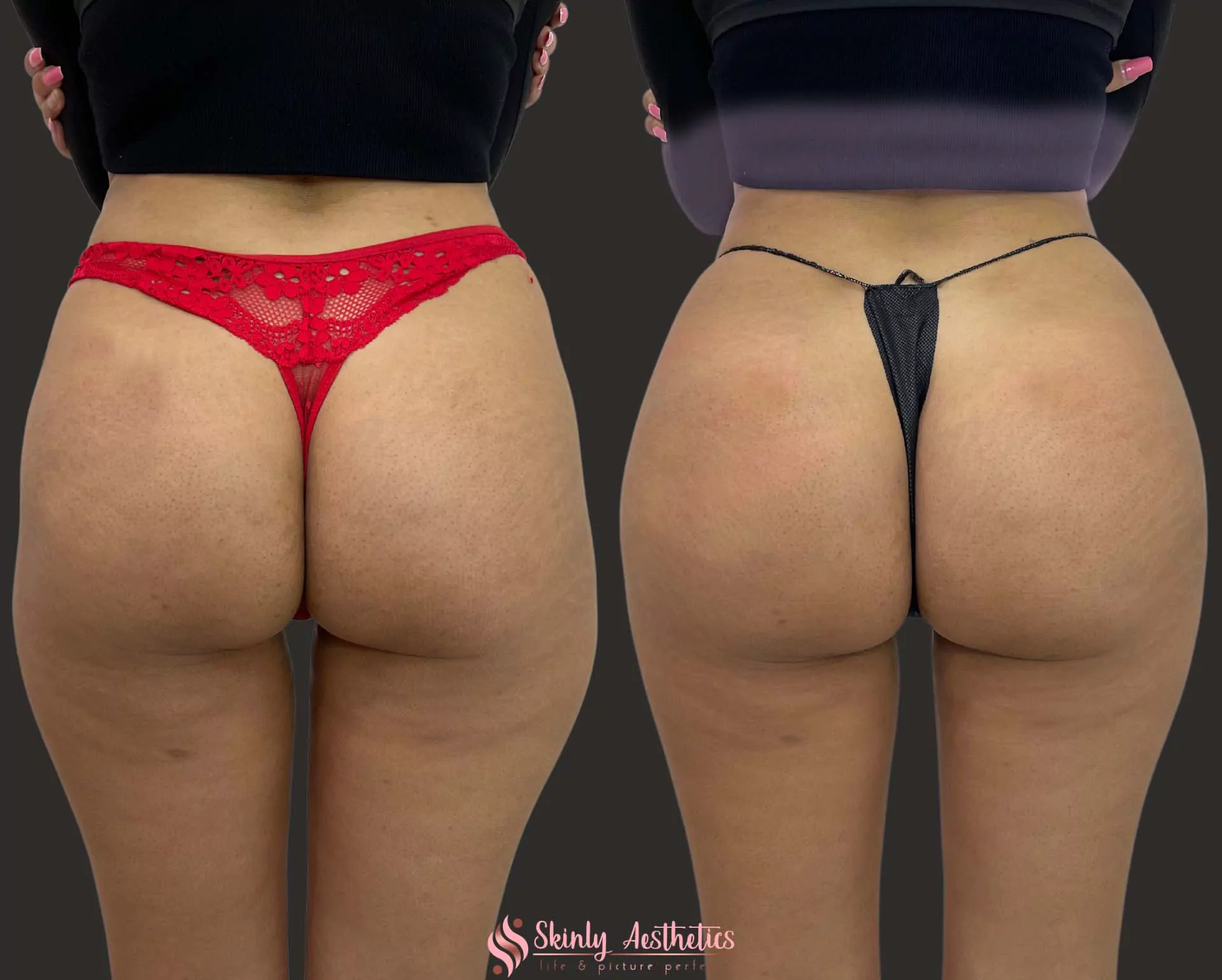 sculptra butt