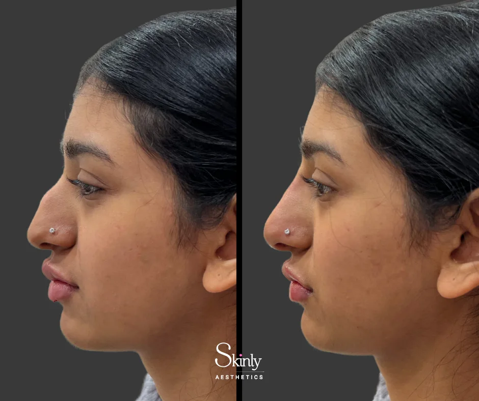 Before and after liquid rhinoplasty, showing refined nose contour.