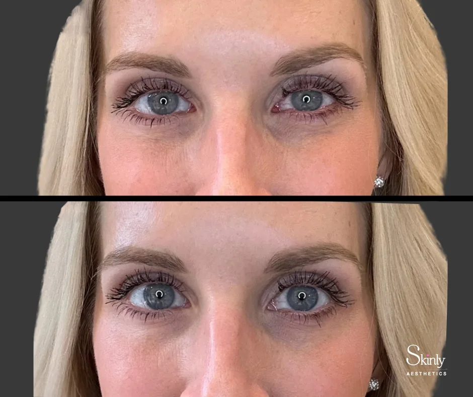 Before and after Upneeq, showing refreshed appearance.