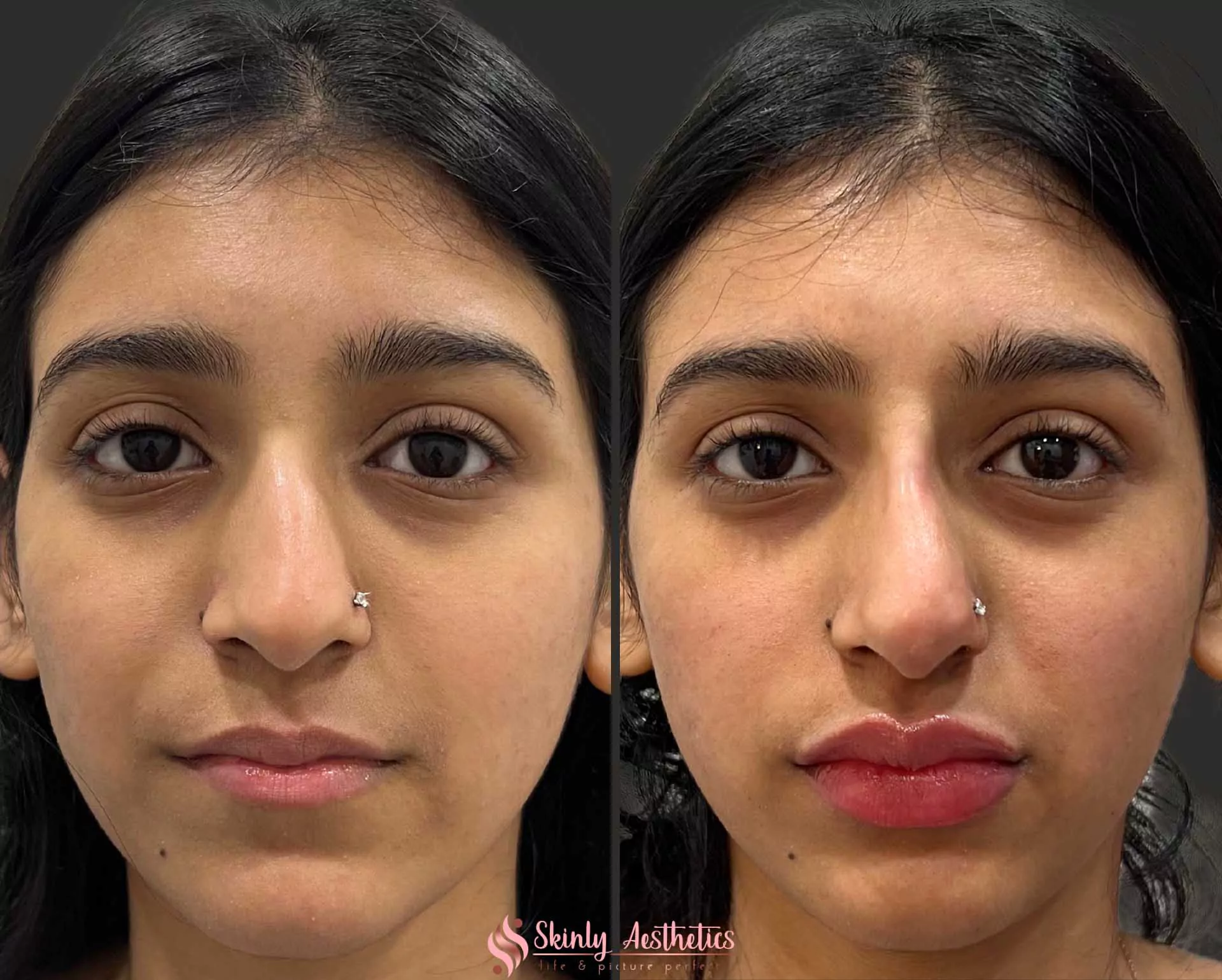 Russian doll style lip injection technique
