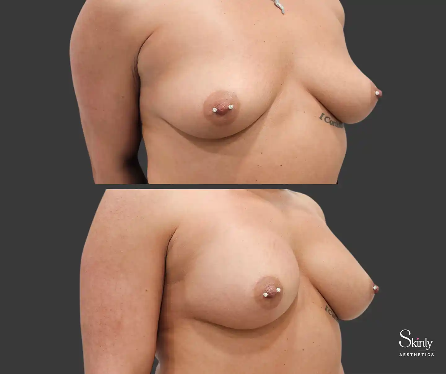 NYC patient before and after results of breast filler treatment from a 45 degree angle