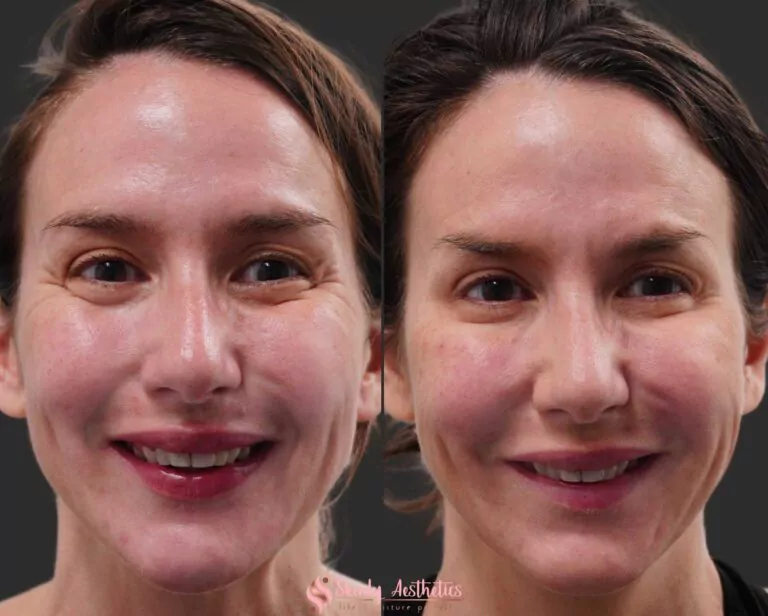 Botox treatment for crows feet