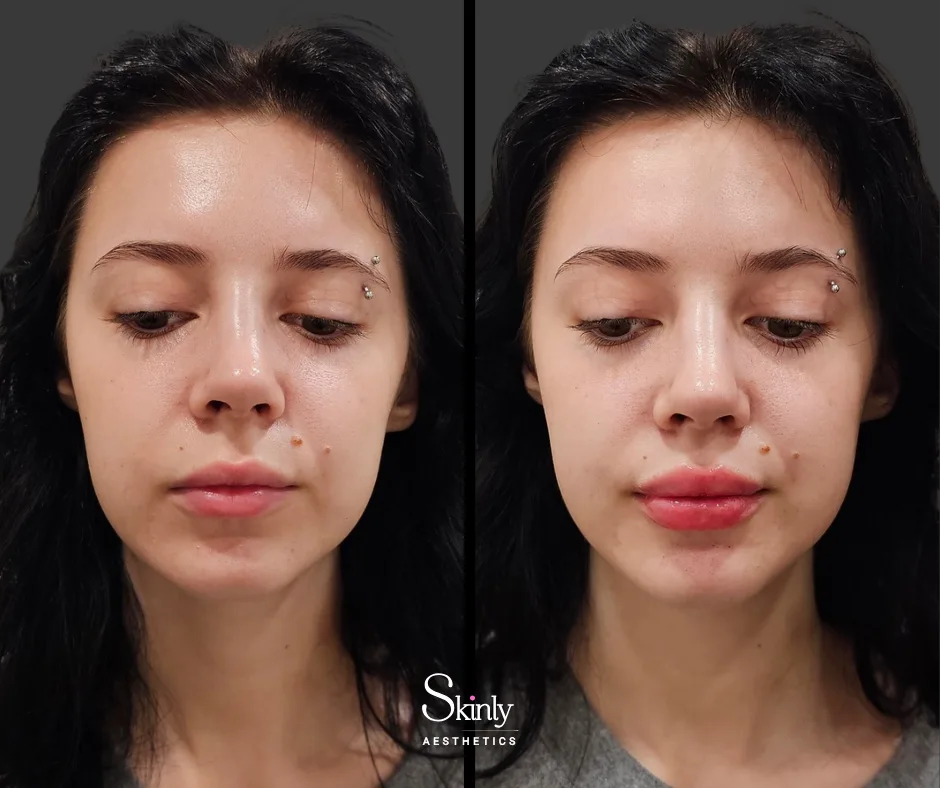Before and after lip injections showing balanced shape.