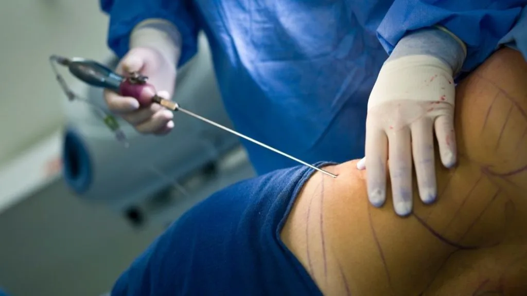 Cannula-based fat transfer breast procedure for breast enhancement treatment