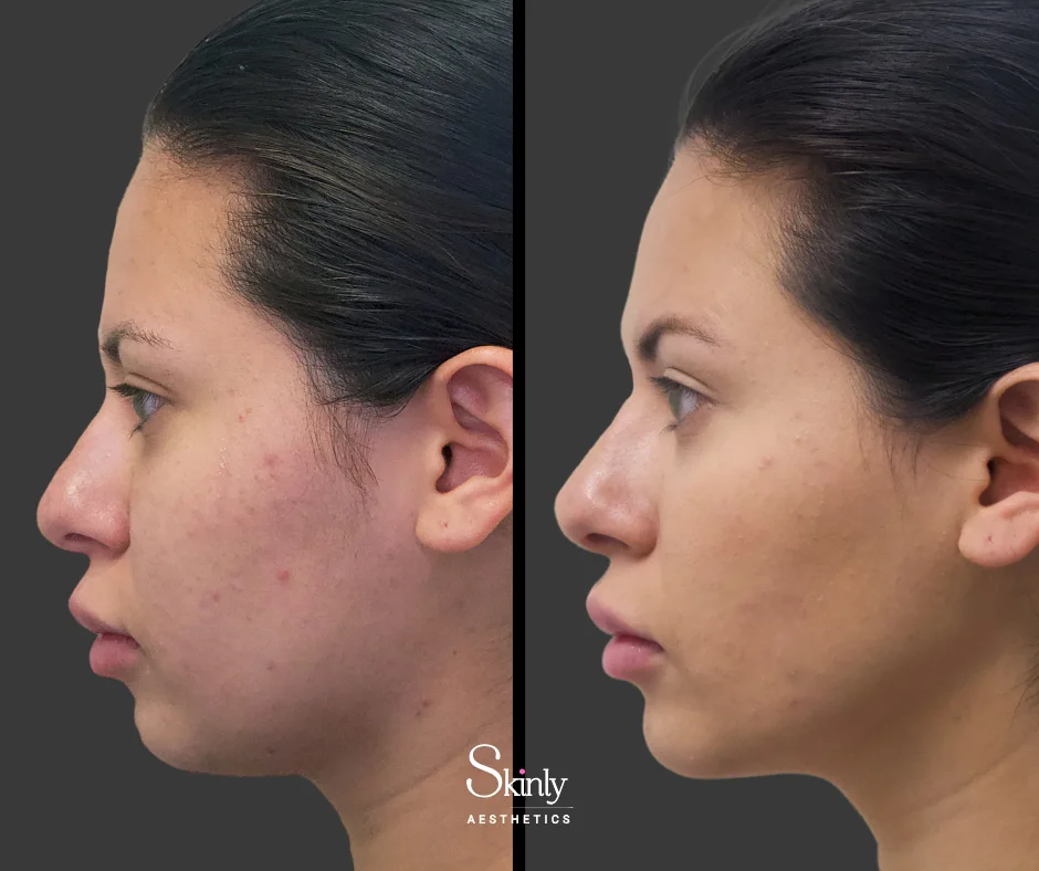 Before and after chin filler on a female showing improved chin contour.