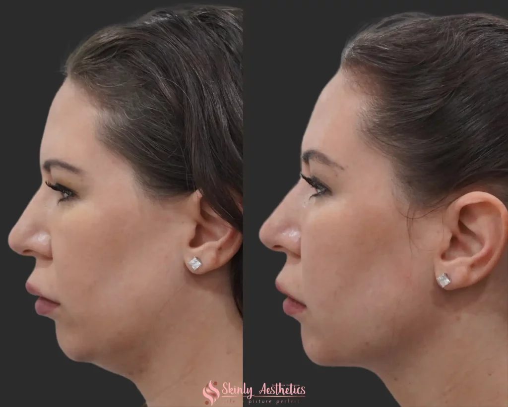 Side view before and after Kybella injections illustrating noticeable improvement in jawline contour and reduction in chin fat.