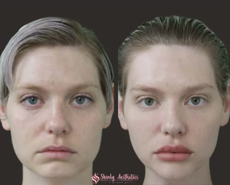juvederm ultra lip augmentation