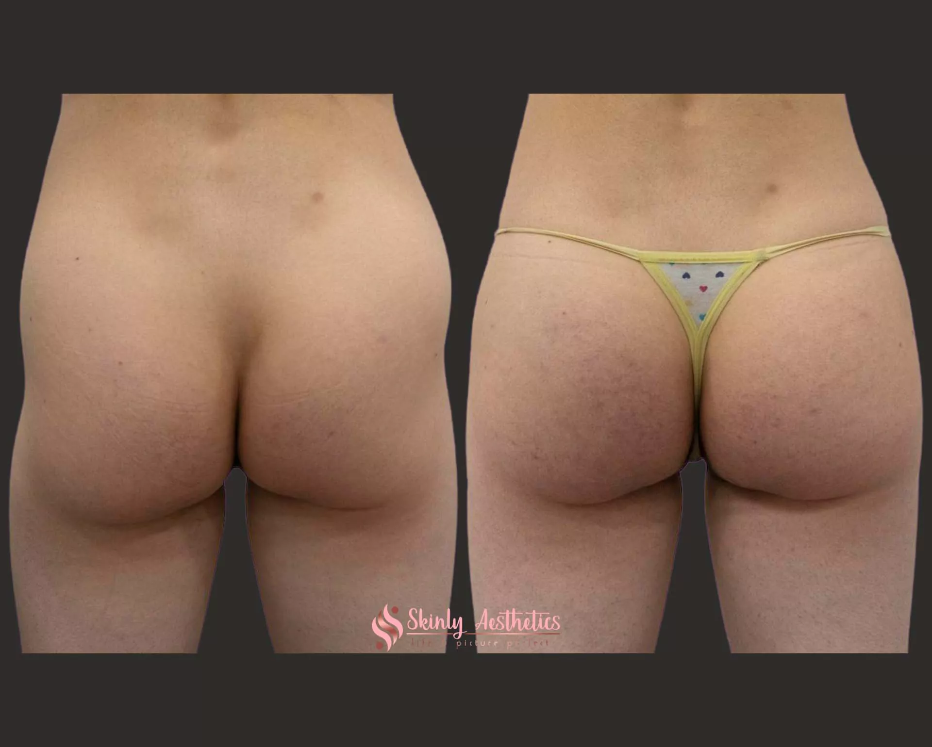 Sculptra hip dips treatment